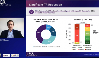 Promising Early Results for TriClip in Tricuspid Regurgitation: bRIGHT Registry